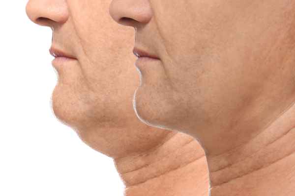 HIFU - Breakthrough in Anti - ageing 2 hifu results Banbury