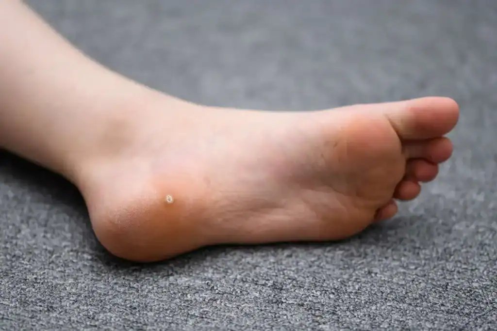 Cryotherapy For Warts And Also Verrucas 2 Image of verruca on the bottom of the foot that able to be treated with Cryotherapy Banbury