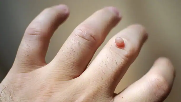 Image of blemish that Cryotherapy Banbury can remove with Lipo 360.