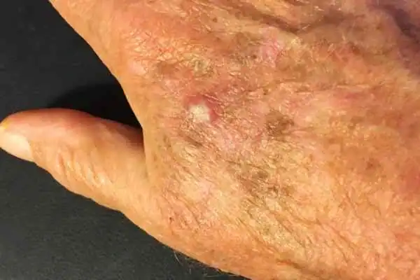 Image of Actinic keratoses Banbury on a person hand