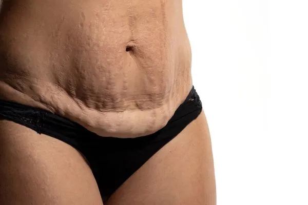 The science behind skin tightening Banbury picture of a woman's sagging skin on the stomach
